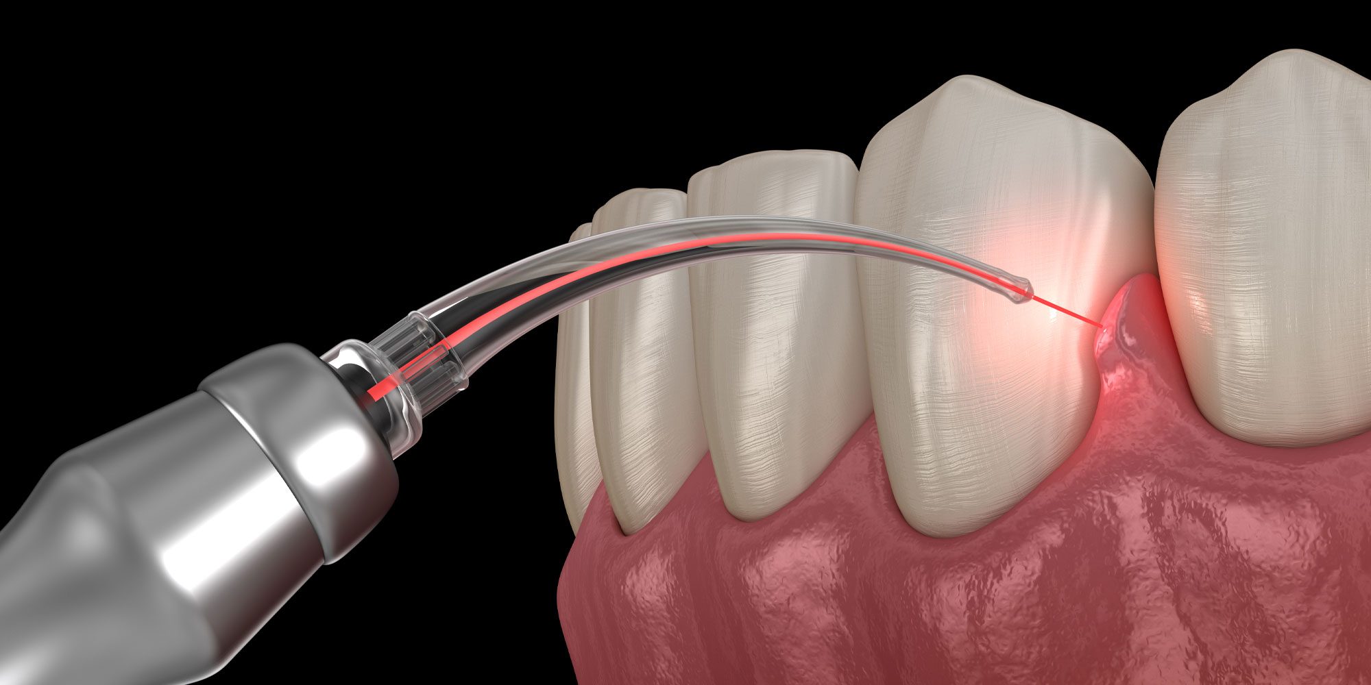 dental laser graphic treating gum disease
