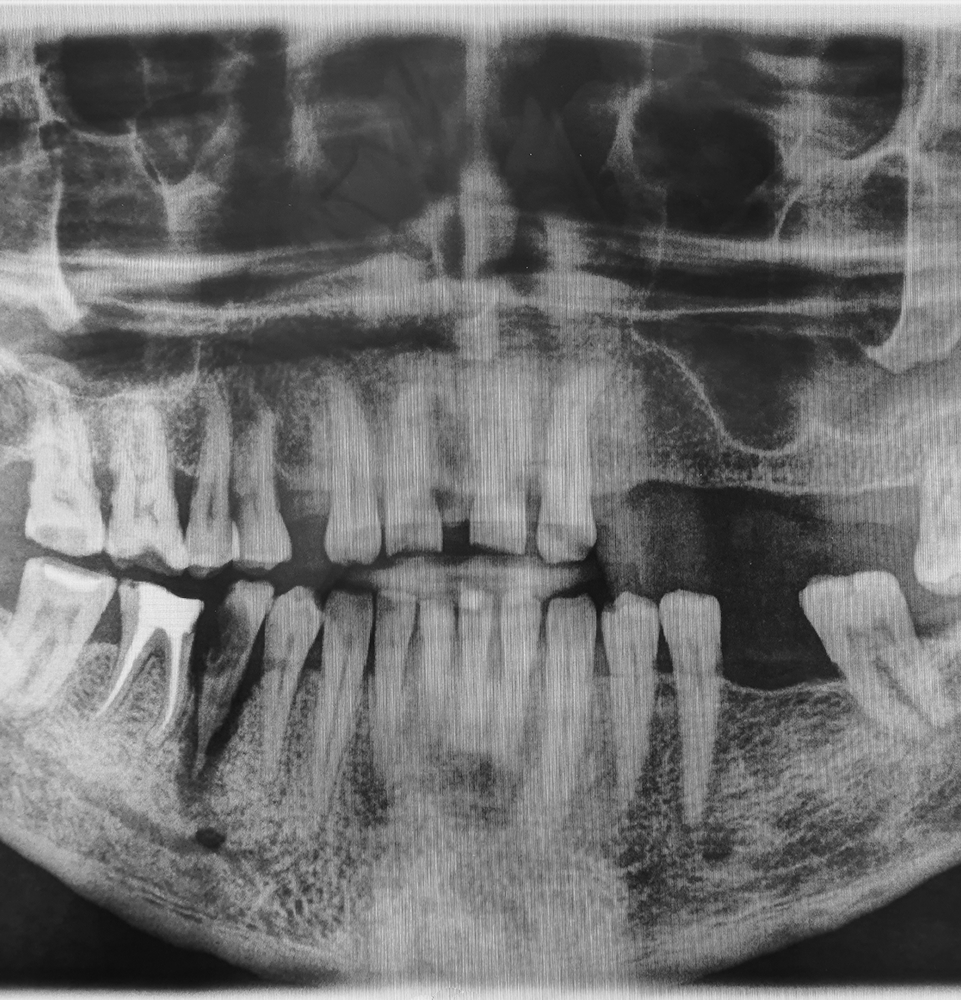xray with missing teeth