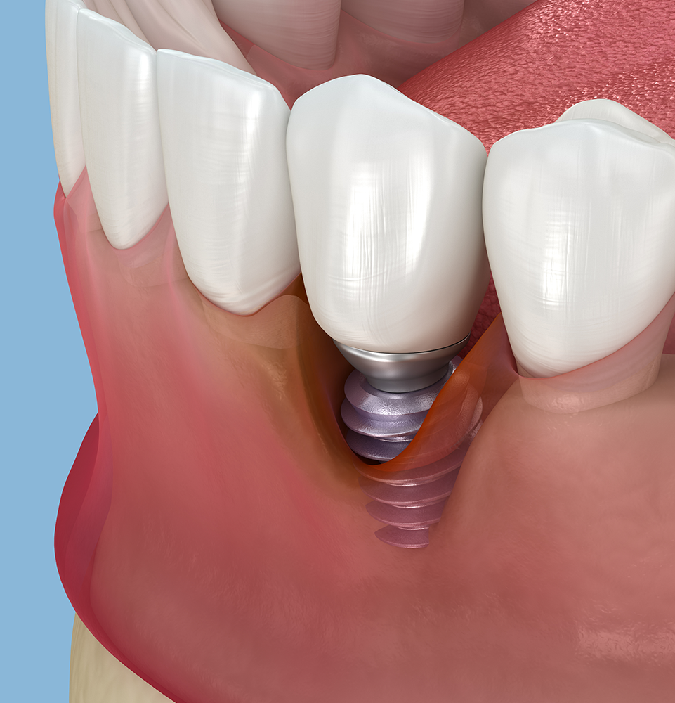 example of peri-implantitis