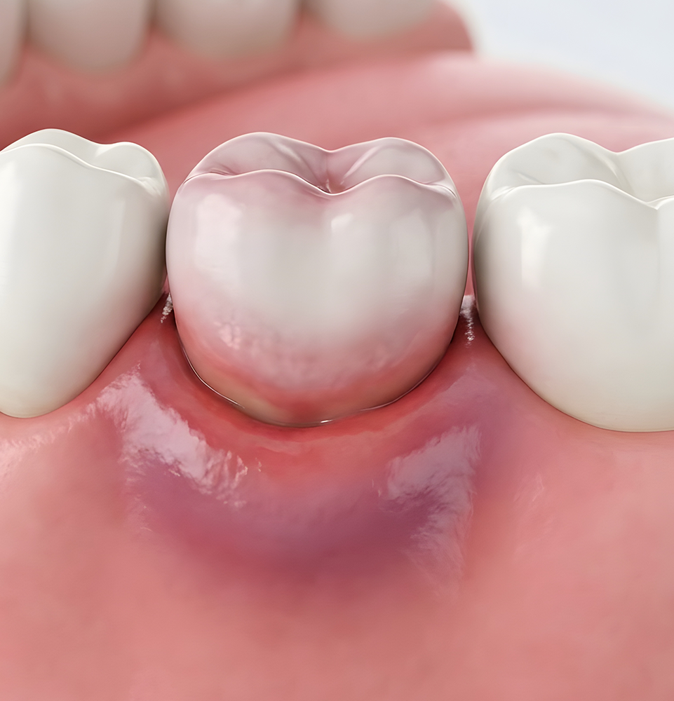 illustration of an inflamed tooth
