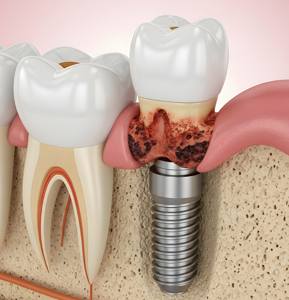dental implant infection