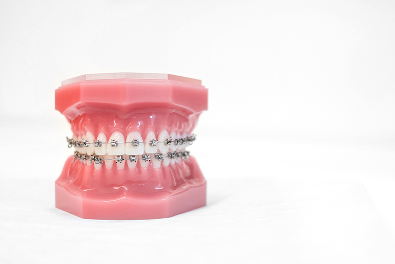 Traditional metal braces on a dental model