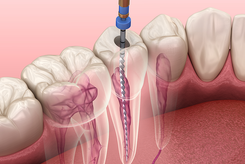 illustration of a root canal procedure