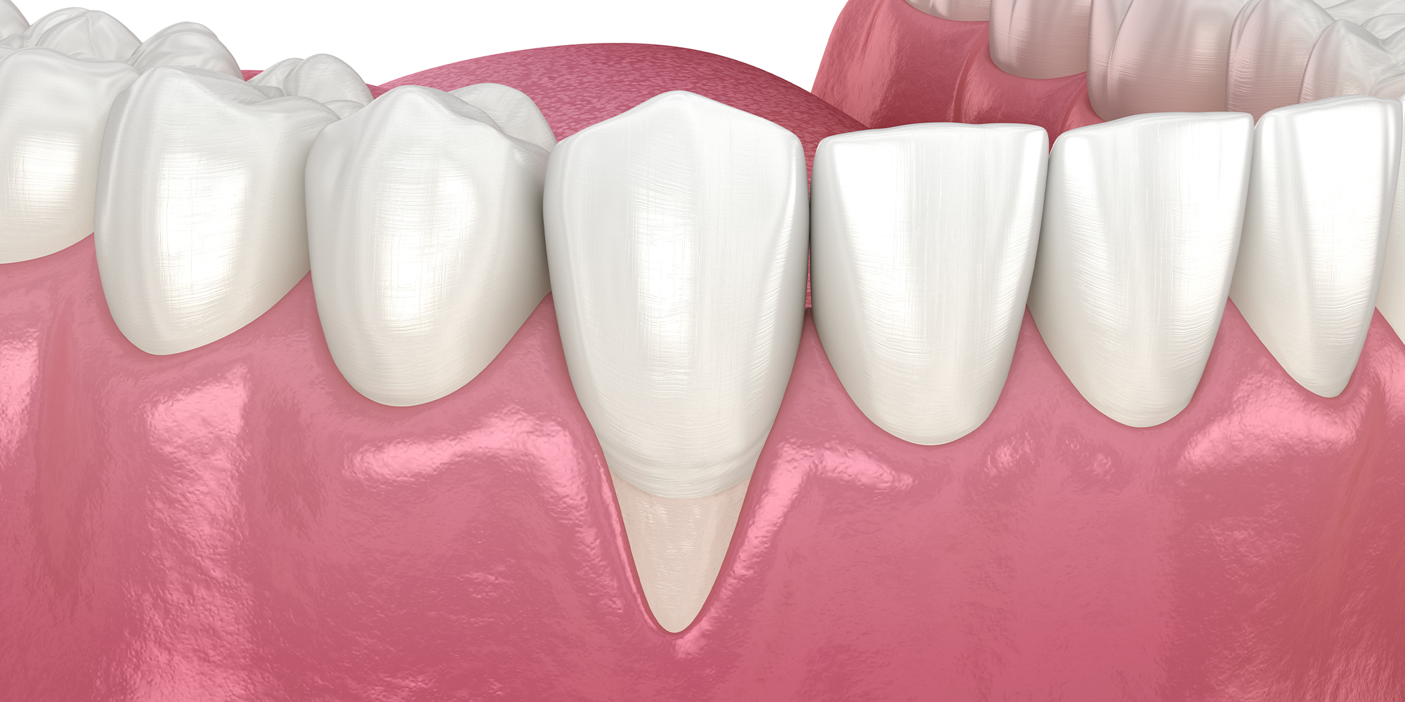 infographic of gum recession
