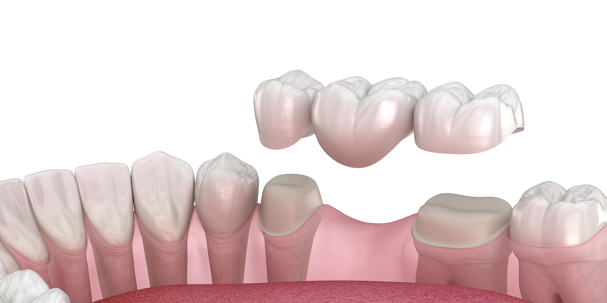 illustration of a dental crown and bridge