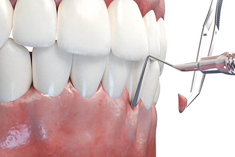 example of performing gum grafting
