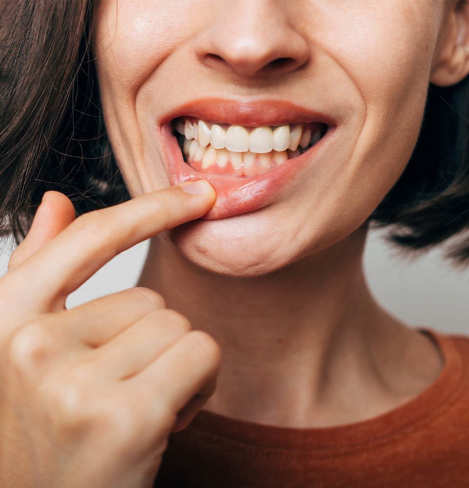 mid-aged woman with gum disease