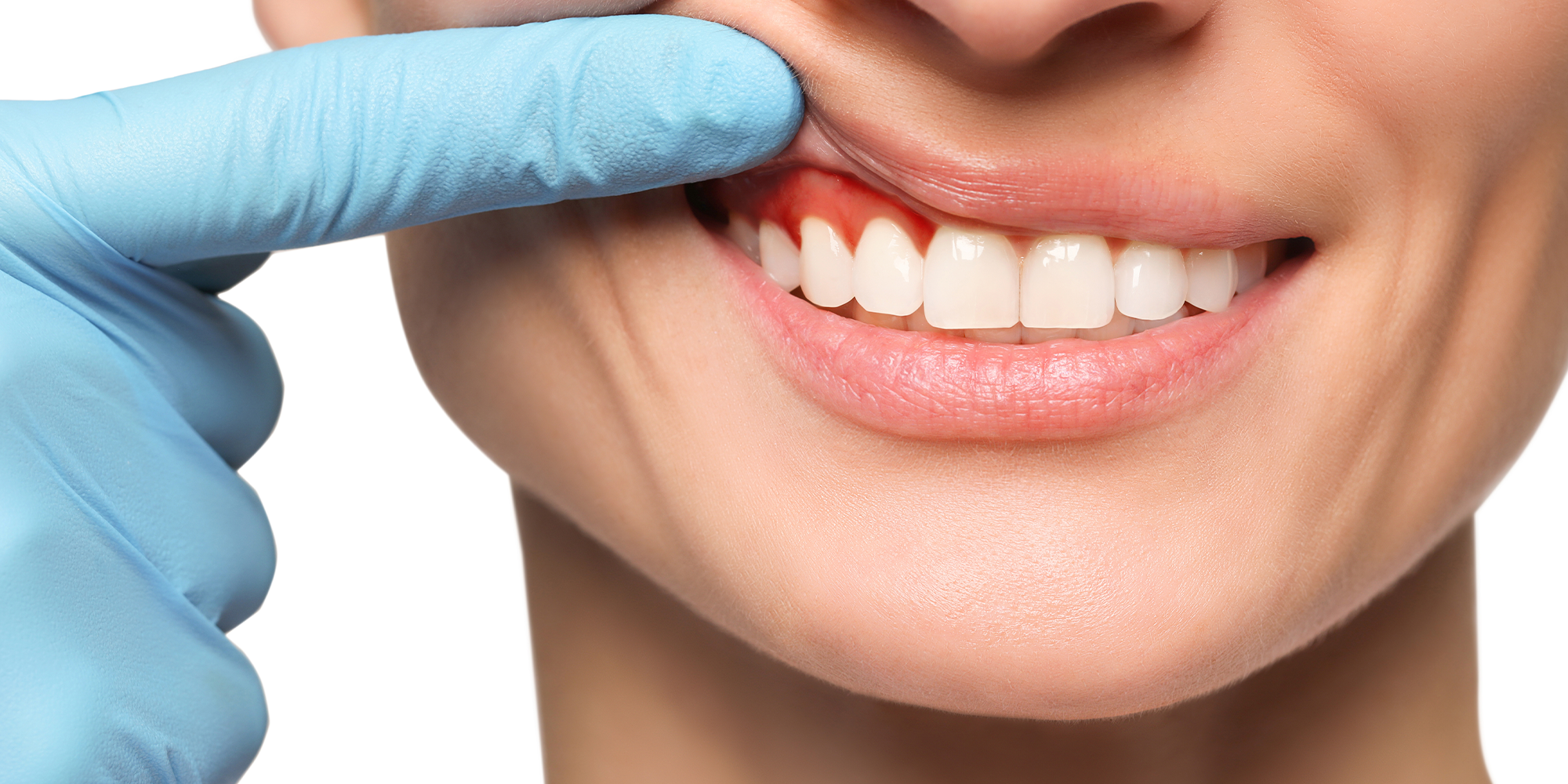 a hand in a blue dental glove lifting the roof of a lip to show gum disease
