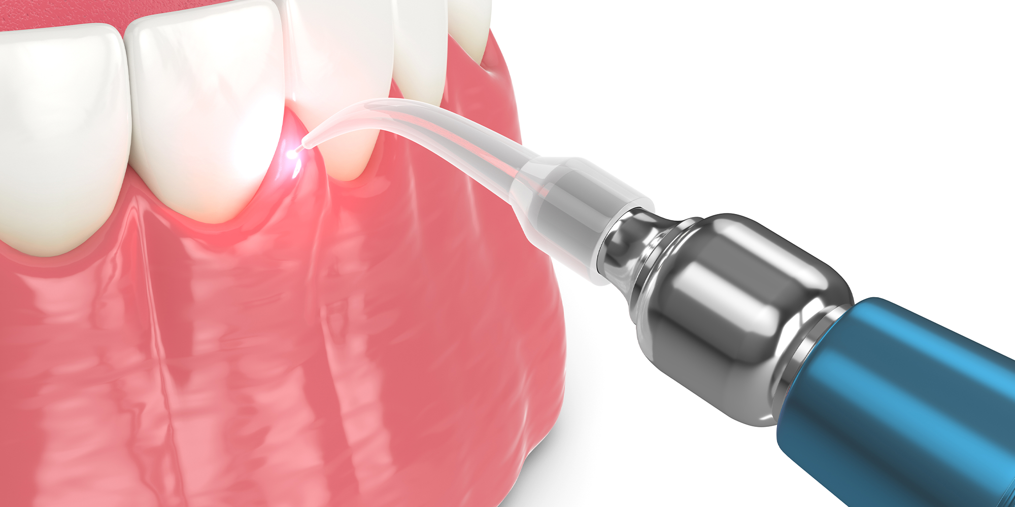illustration of a laser during the LANAP procedure