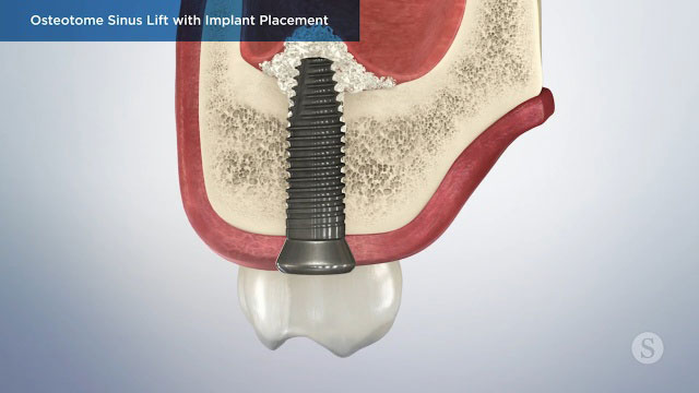Patient Education Video 3 Thumbnail